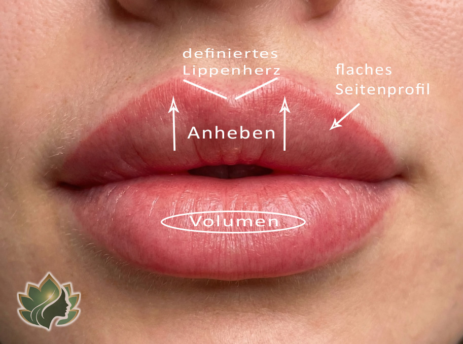 Russian Lips Lippenaugmentation Russian Lips Lippenaugmentation
